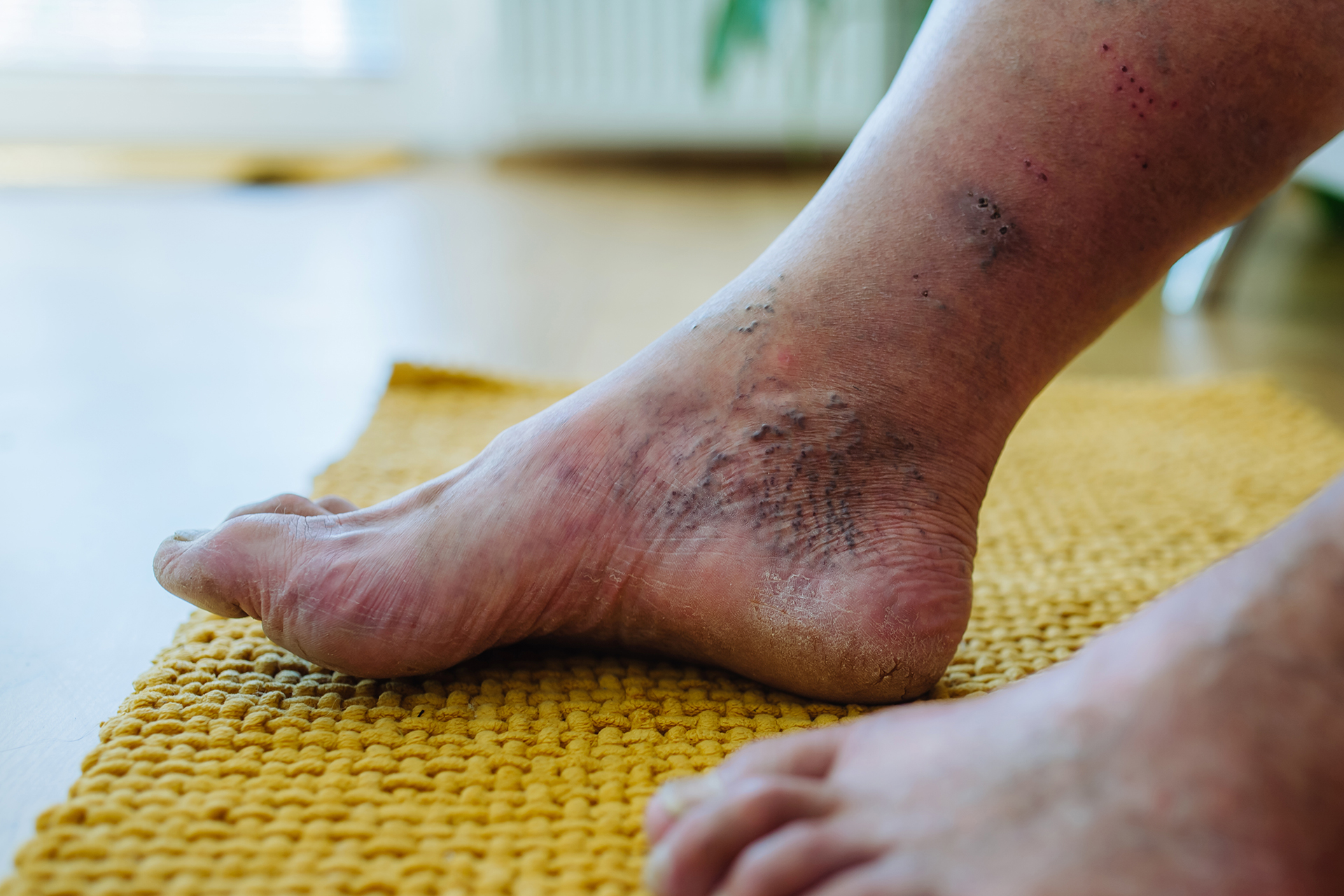 Comprehensive Diabetic Foot Ulcer Management Advanced Care and Long-Term Solutions